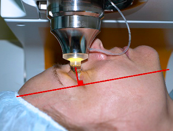 Неправильное положение головы при лазерной коррекции фемто лазик