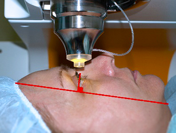 Неправильное положение головы при лазерной коррекции фемто лазик