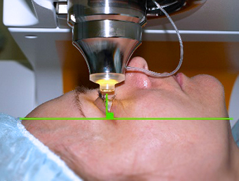 Правильное положение головы при лазерной коррекции фемто лазик